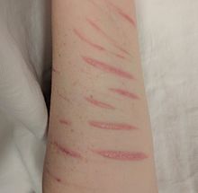 SelfHarm2017